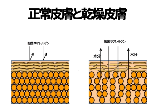 正常皮膚と乾燥皮膚